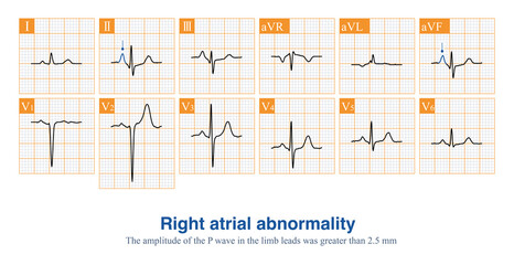 Wall Mural - Male, 67 years old, with a clinical diagnosis of chronic obstructive pulmonary disease. ECG showed sinus rhythm and right atrial abnormality.
