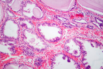 Poster - Benign prostatic hyperplasia, light micrograph