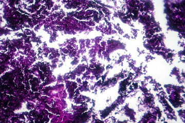 Poster - Photomicrograph of lung tissue with silicosis pathology under a microscope, revealing silica particle accumulation in alveoli and fibrosis.