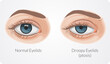 © Design Praxis - Ptosis drooping upper eyelid - Stock Illustration