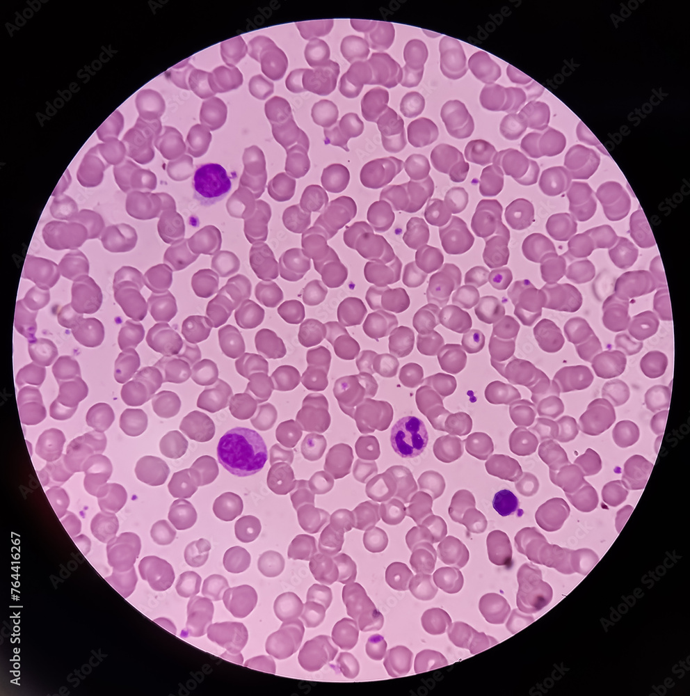 Monocyte Rbc Fotografie Photomicrograph of hematological slide showing RBC, WBC ...