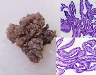 Wall Mural - Papillary borderline serous tumor of the ovary (low malignant potential) with microscopic image stratified cells, nuclear atypia. Ovarian serous borderline tumors.