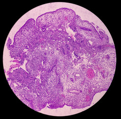 Wall Mural - Microphotograph of endometrial tissue, reveals decidual change with necrosis and hemorrhage. Endometriosis. Endometrial or uterine cancer diagnosis.