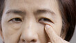 © toa555 - Senior asian woman worry about eye bags and dark spot.