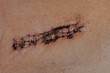 wound with surgical suture staples
