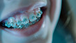 Close-up of a smiling mouth with orthodontic braces on the teeth, indicating dental care and the process of aligning teeth for a healthy smile.