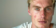Photo of a blond man with blue eyes with a scar on his face against a light background. Banner for cosmetology with an image for copying on the left.