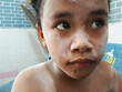 Selective focus portrait of elementary age girl using powder for itching due to chickenpox. Wellness home care treatment chickenpox because varicella zoster virus