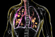 Lungs affected by cystic fibrosis, 3D illustration
