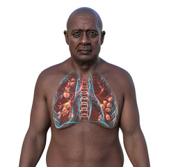 Poster - A man with lungs affected by cystic fibrosis, 3D illustration