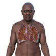 A man with lung miliary tuberculosis, 3D illustration