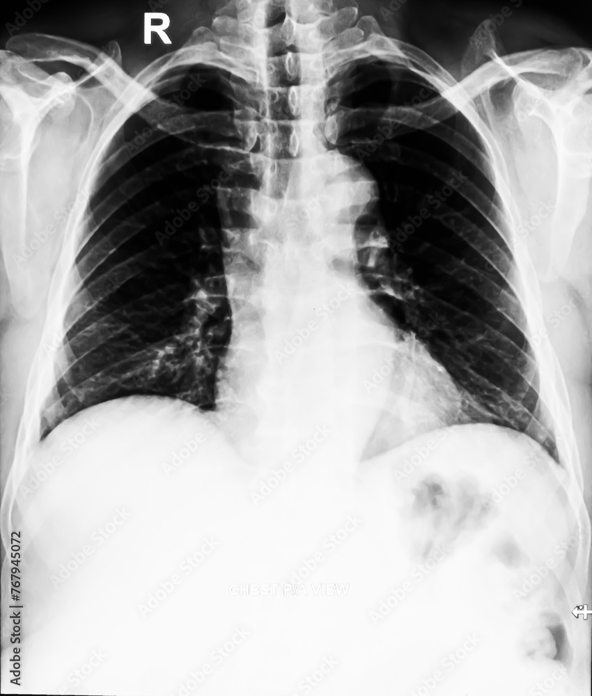 CXR (Chest X-Ray) PA view. Cervical ribs, normal findings. の Stock フォト ...