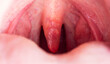 © HENADZY - Inflammation of the uvula in the oral cavity due to infection and virus. Treatment of the disease is uvulitis. Red throat due to illness, close-up