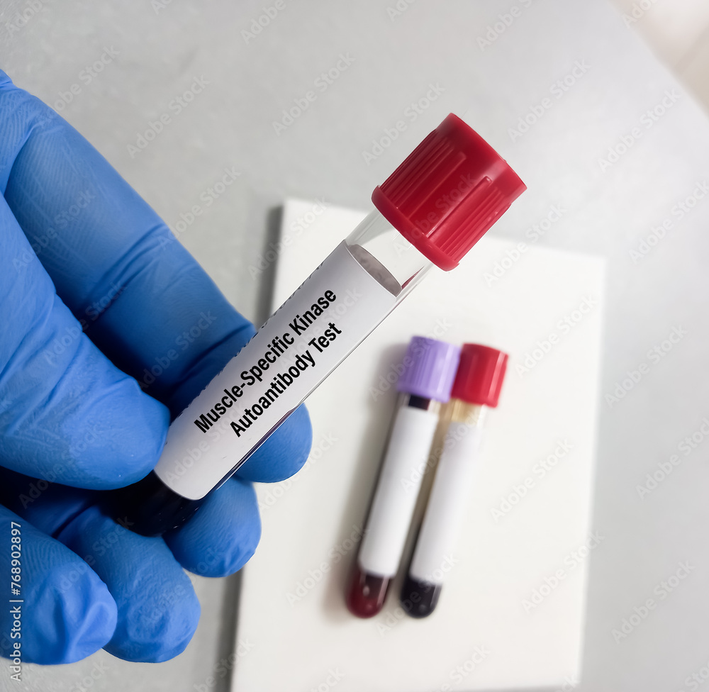 Blood sample for MuSK(muscle-specific kinase) protein test to diagnosis Myasthenia gravis disease. Autoimmune disease.