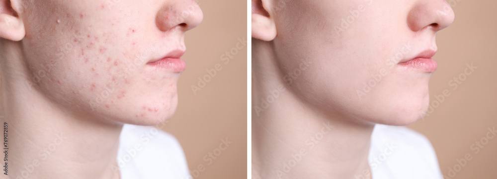 Acne problem. Young man before and after treatment on beige background ...