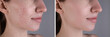 © New Africa - Acne problem. Young woman before and after treatment on grey background, closeup. Collage of photos