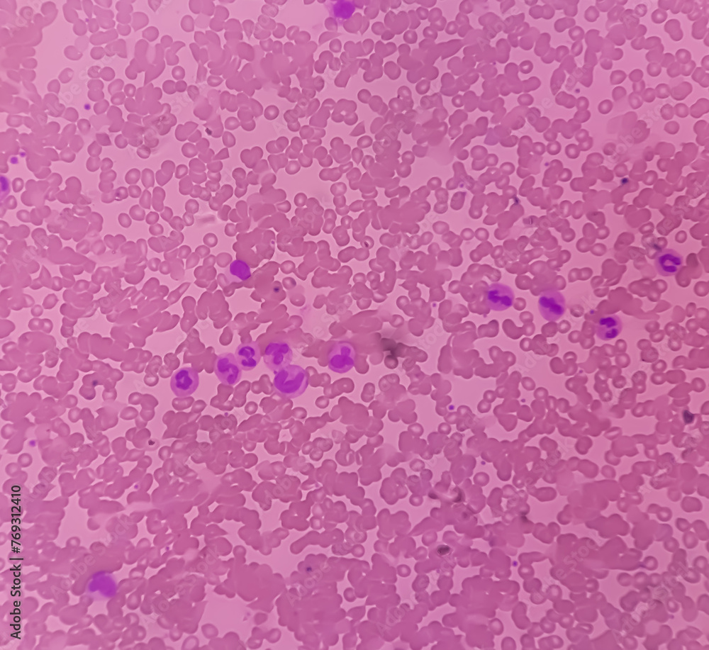 Photomicrograph Show Acute Immuno hemolytic Anaemia Cold Hemagglutinin Photomicrograph show acute immuno hemolytic anaemia cold hemagglutinin