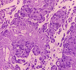 Canvas Print - Astrocytoma, Intramedullary SOL (C5-D3) tissue biopsy. Photomicrograph show malignant neoplasm of oval to elongated cells with eccentric cuclei and eosinophilic cytology. Micovascular proliferation.