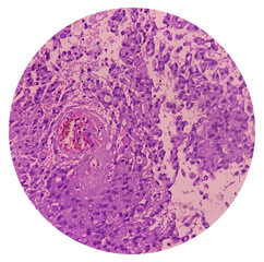 Poster - Astrocytoma, Intramedullary SOL (C5-D3) tissue biopsy. Photomicrograph show malignant neoplasm of oval to elongated cells with eccentric cuclei and eosinophilic cytology. Micovascular proliferation.