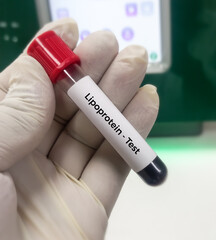 Poster - Blood sample for lipoprotein test. Lipid profile. to diagnosis of high risk for heart disease and stroke. Bad cholesterol medical testing concept.