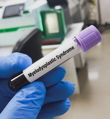 Canvas Print - Blood sample for Myelodysplastic syndrome test. To diagnose MDS – a full blood count and a bone marrow biopsy.