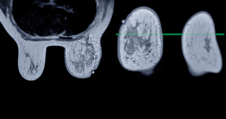 Wall Mural - Breast MRI revealing BI-RADS 4 in women indicates suspicious findings warranting further investigation for potential malignancy.