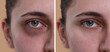 © New Africa - Collage with photos of woman with dark circle under eye before and after treatment on beige background, closeup