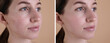 © New Africa - Acne problem. Young woman before and after treatment on beige background, collage of photos