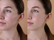 © New Africa - Acne problem. Young woman before and after treatment on beige background, collage of photos