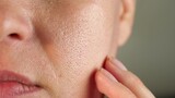 Problem skin with dilated and enlarged pores. Close-up of a woman face. Oily skin. oily shine
