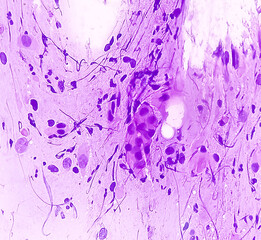 Canvas Print - Light micrograph of a vaginal smear showing adenocarcinoma cells (center). Vaginal cancer. Inflammatory smear with HPV related changes. Cervical cancer. SCC.