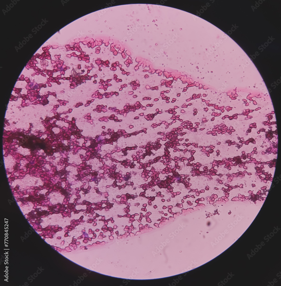 Microscopic Image Of Ankle Joint Fluid Osteochondroma Disease microscopic-image-of-ankle-joint-fluid-osteochondroma-disease