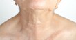Scar on neck from thyroid removal surgery in senior adult woman.