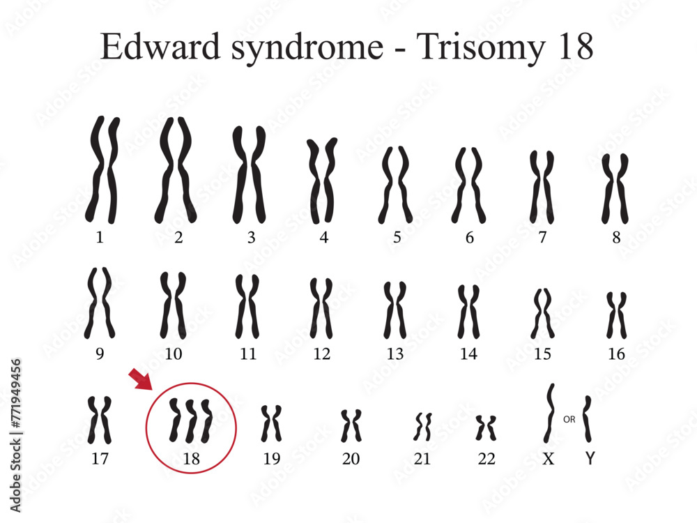 Karyotype of Edward syndrome also known as trisomy 18 is a genetic ...
