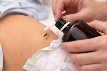 Mother hands cleaning newborn baby navel with a cotton swab and hydrogen peroxide. Treat the navel of a newborn baby. Closeup. 