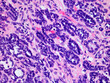 Microscopic Image of a Wilms Tumor or Nephroblastoma of a Childs Kidney Viewed at 400x Magnification with Hematoxylin and Eosin Staining. One of the most Common Cancers Affecting Children
