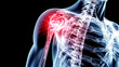 Illuminated Shoulder Pain Indicator on Human Skeleton X-ray