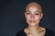 jeune femme chauve souffrant alopécie suite à un traitement de chimiothérapie pour soigner un cancer, espace pour texte sur le côté
