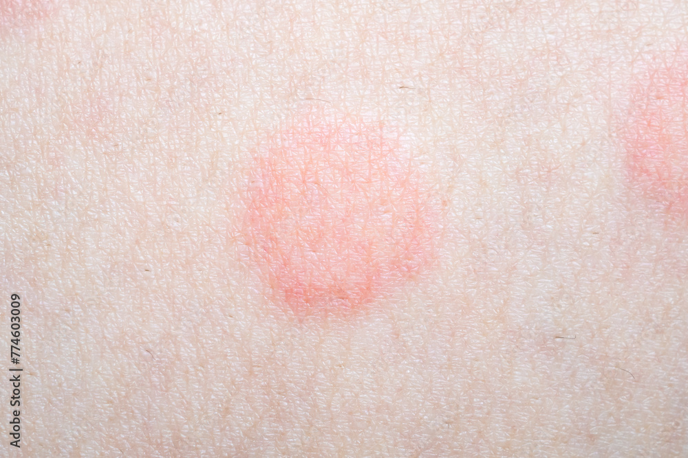 Red Rash Texture Skin allergy rash dermatitis texture close up Stock Photo | Adobe Stock