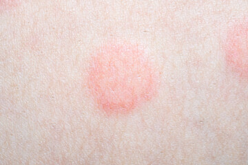 Skin allergy rash dermatitis texture close up