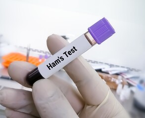 Sticker - Blood sample for HAM'S Test to diagnose paroxysmal nocturnal hemoglobinuria (PNH).