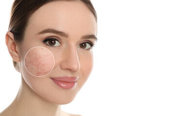 Poster - Dermatology. Woman with skin problem on white background. Zoomed area showing acne