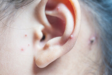 Symptoms of chickenpox in childhood