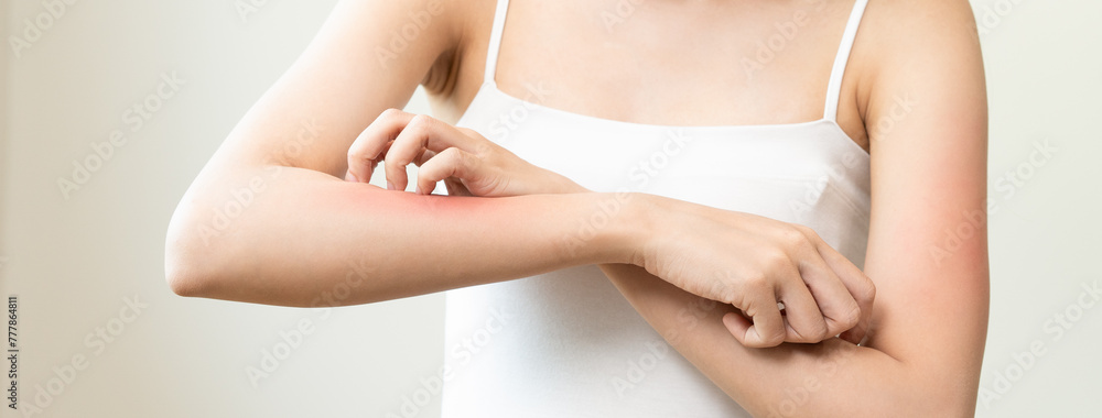 Dermatology, asian young woman reaction from atopic, insect bites on ...