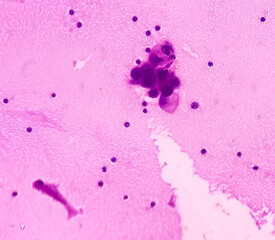 Poster - Ascitic fluid cancer. Metastatic adenocarcinoma. Smear show atypical epithelial cells, show moderate pleomorphism.