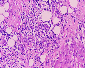 Poster - Inguinal lymph node (excised): Lymphoproliferative disorder (LPD). Section show lymph node.