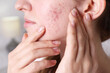 © New Africa - Woman with acne problem at home, closeup