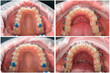 Close-up photo before and after braces are installed. Upper and lower jaw.