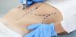 Doctor plastic surgeon drawing preoperative markings on skin of patient abdomen closeup. Plastic surgery and aesthetic medicine liposuction concept