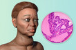Grave's disease in a woman, 3D illustration and light micrograph of toxic goiter